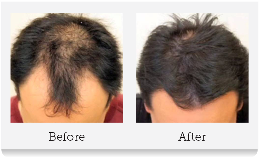 Hair Transplant Results